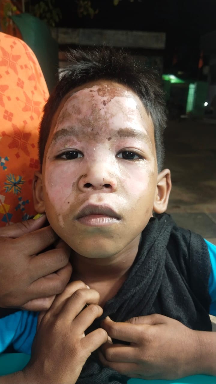 Ayush Before Treatment